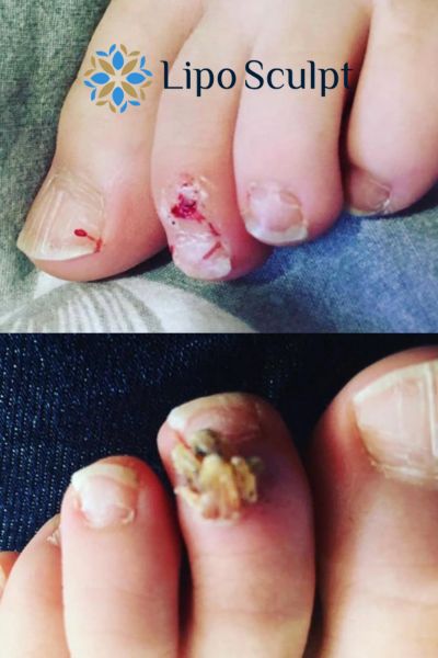 Wart removal customer results from Lipo Sculpt Banbury